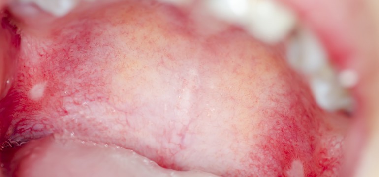 Macro close up and depth of field (DOF) infection  in open mouth - infection of ulcer inside mouth